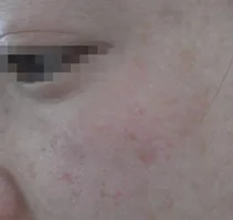 フォトRFしみ治療施術後