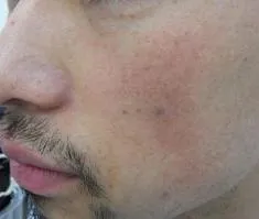 フォトRFによるそばかす改善例